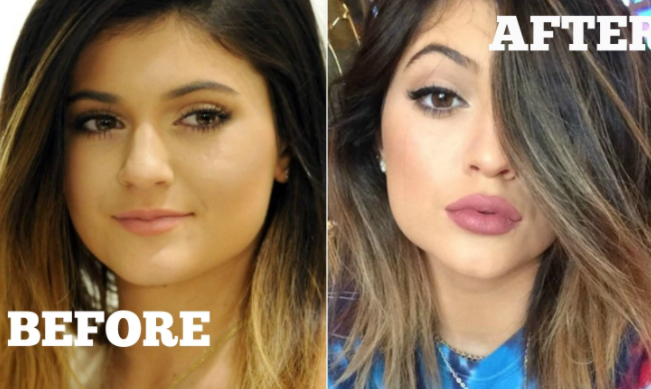 lip fillers